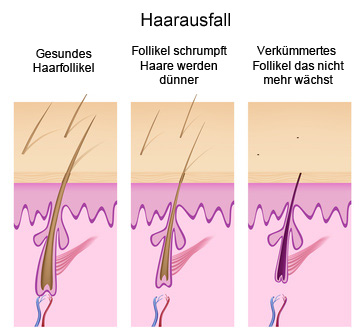 Haarausfall Schema