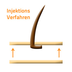 Injektions Verfahren - Hair Injection Toupet